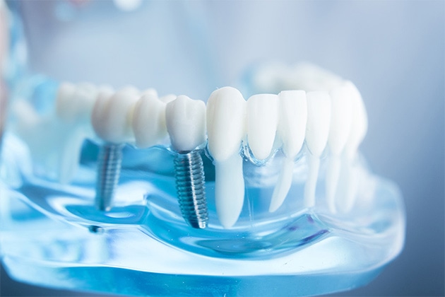 整った設備と技術による治療で天然歯のような噛み心地を実現～インプラント～