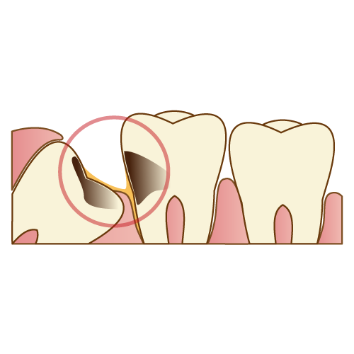 食べものが詰まりやすく虫歯になっている
